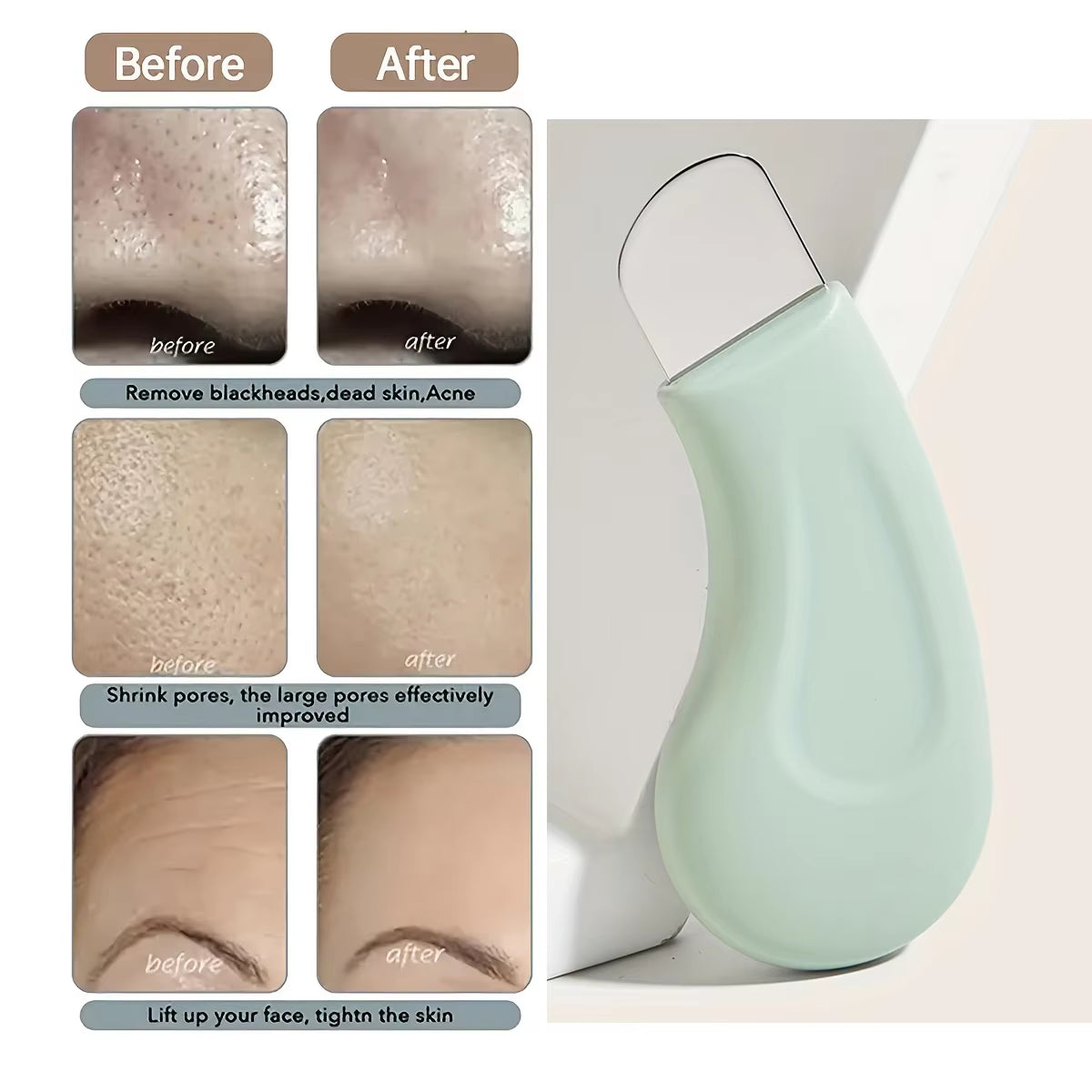 Facial Blackhead Removal Tool, Deep Cleansing, Acne Removal